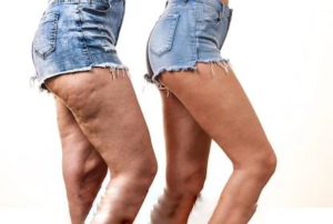 cellulite rimedi